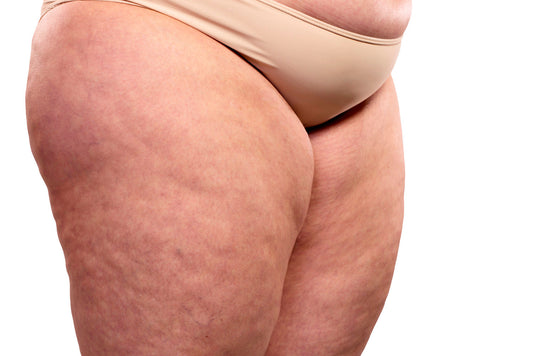 La Cellulite Hormonale : Comprendre et Agir