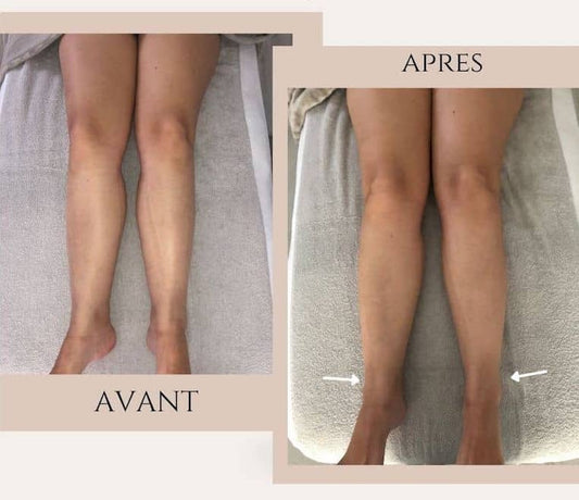 La lymphe : le grand oublié de la silhouette